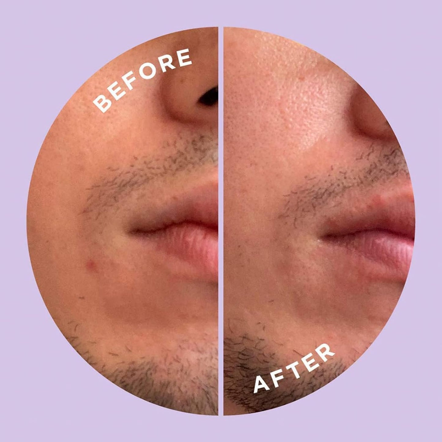 ZitSticka Hyperfade Microdart Pimple Patch, Targets Post-Zit Blemishes, Hydrates & Evens Skin Tone, With Hyaluronic Acid & Vitamin C for Clear, Smooth-Looking Skin (4 count)