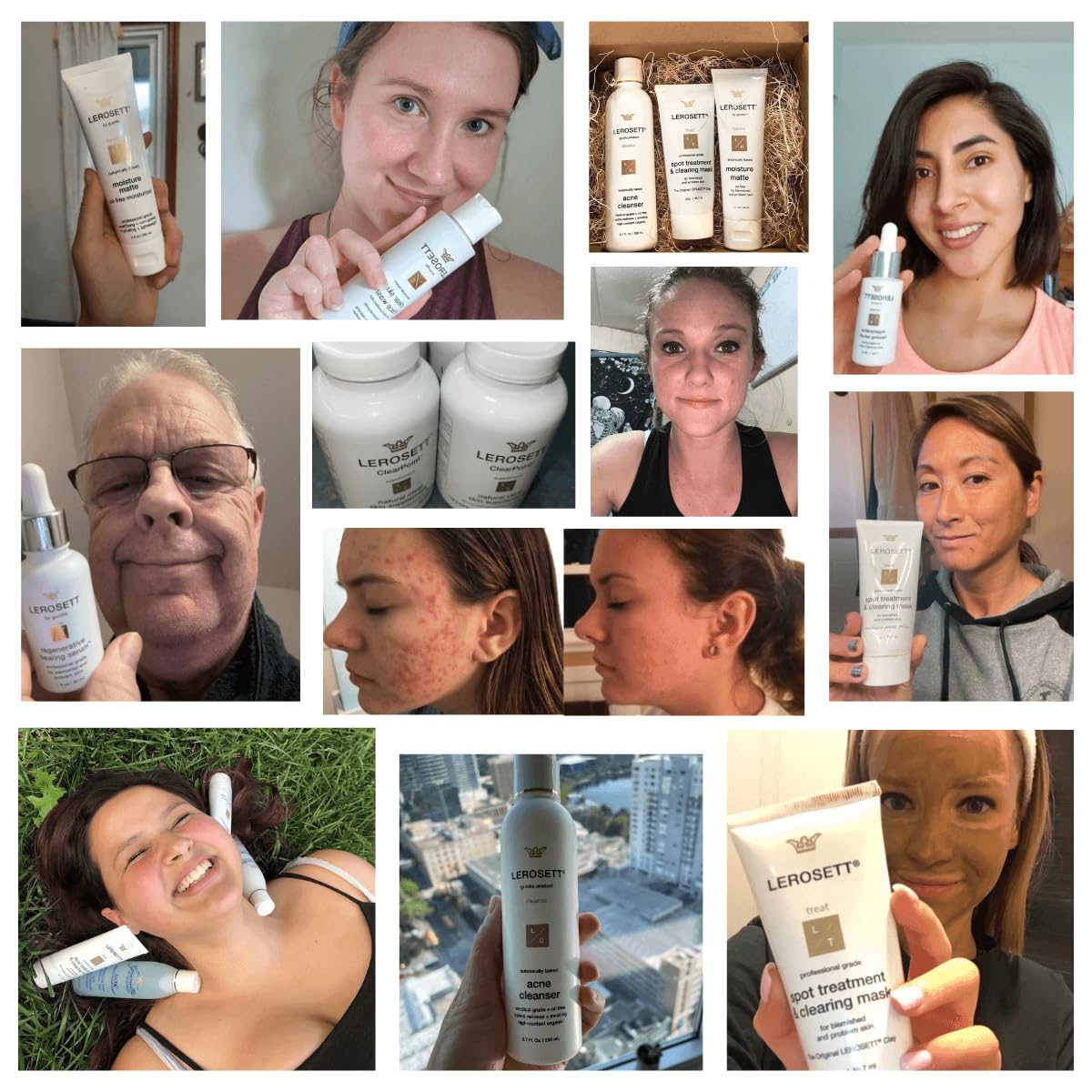 LEROSETT Serum for Acne Scarring Healing, Pimples, Redness, Breakouts, Blemishes, Hydrate & Soothes Irritated Skin, Natural Serum. Spa-Grade, Plant Based, Concentrated - 1 oz