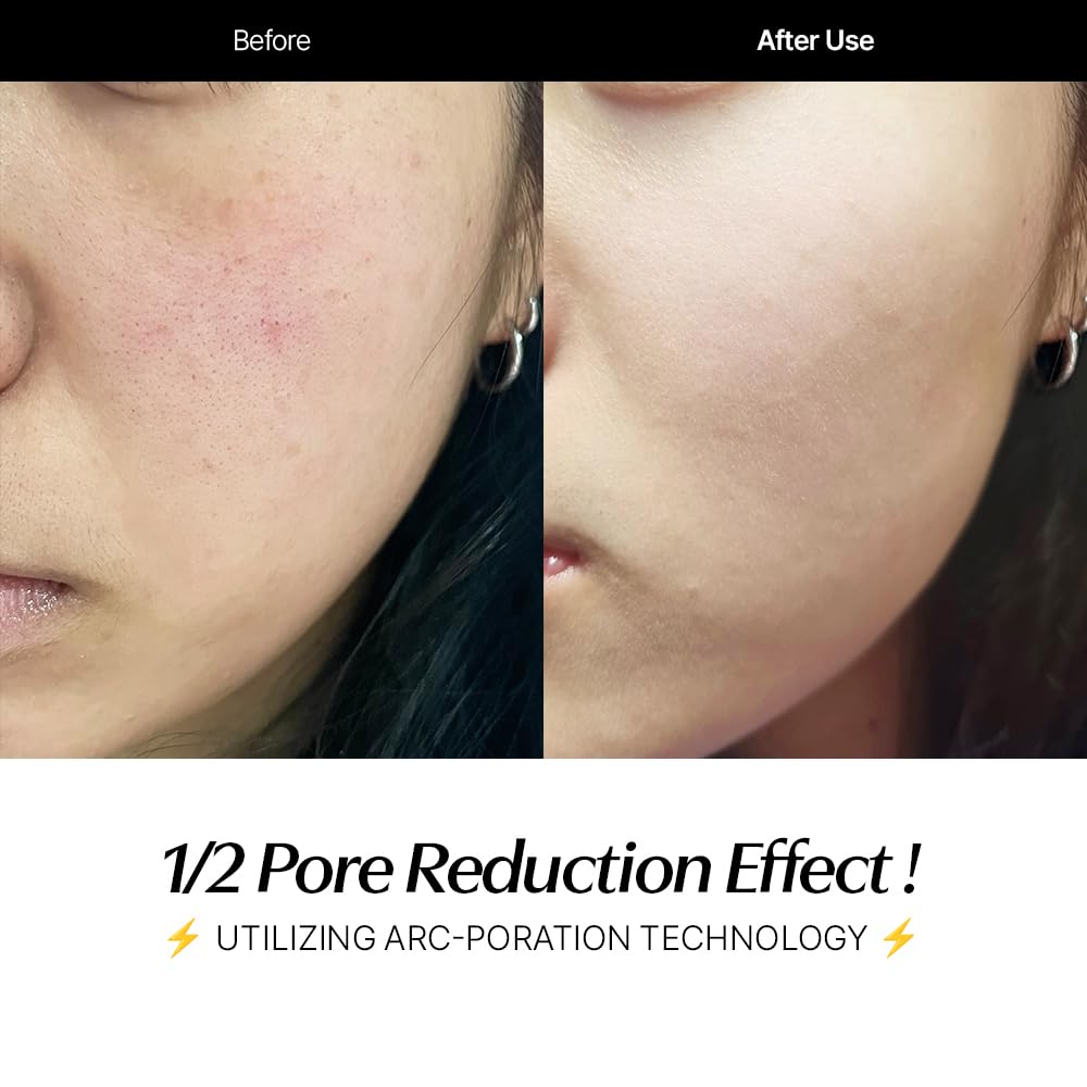 CELORABY Potension Penta-Shot Glass Skin Glow Booster | 5-in-1 Korean Skincare Device for Pore Minimizing, Black Head Care, Enhanced Absorption & Needle-Free Professional Treatment at Home