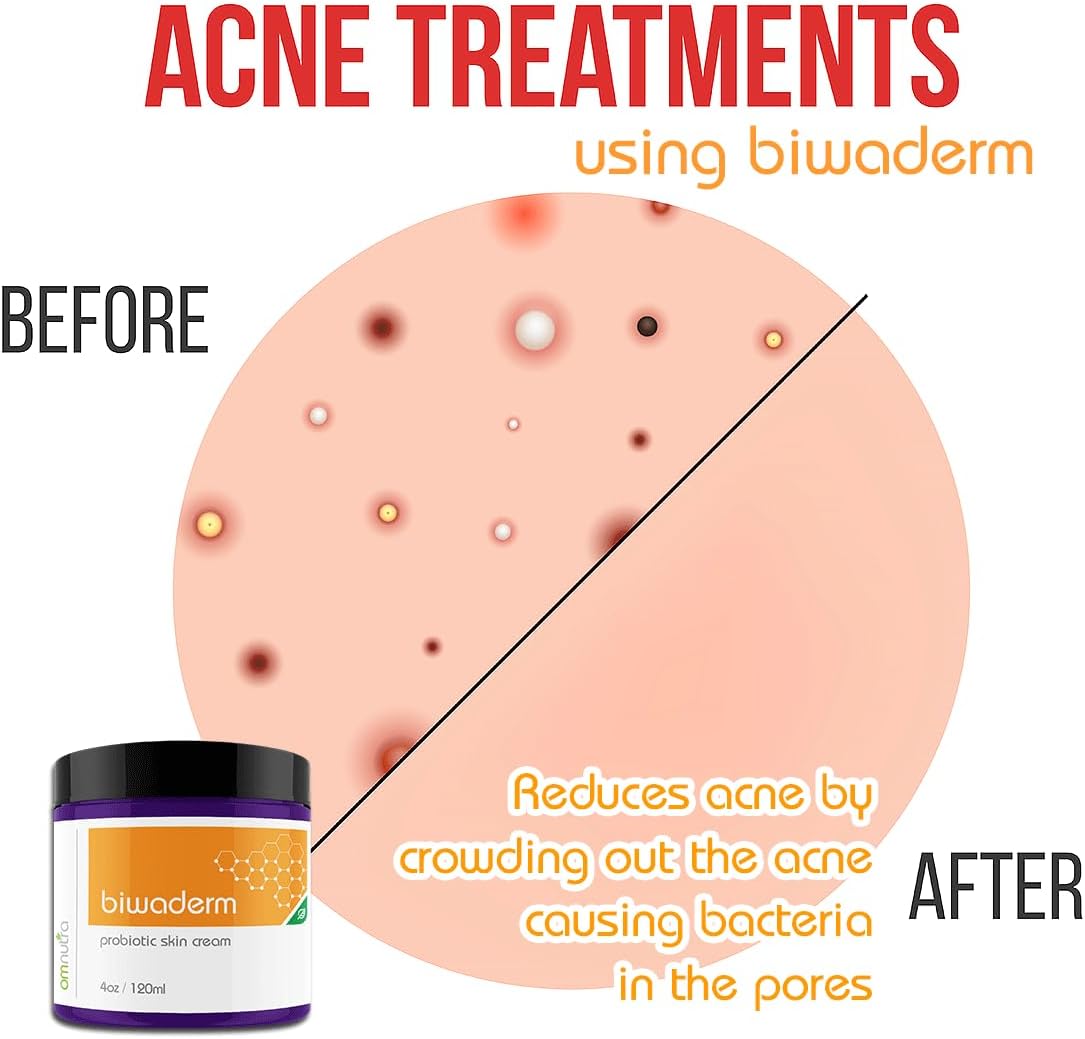 Biwaderm Probiotic Skin Cream - 4OZ Organic Based Topical Probiotics for Skin Care Eczema Treatment Psoriasis Treatment for Folliculitis Treatment Pure Aloe Vera Gel 4oz