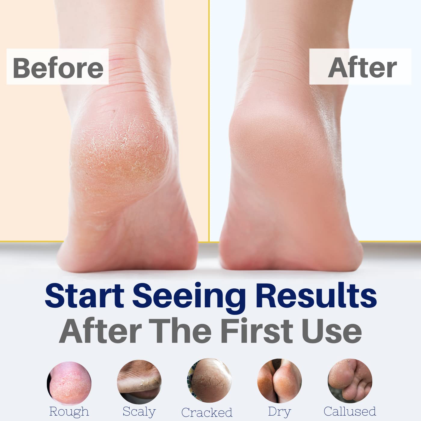 Yellow Bird Natural Foot Cream - For Dry and Cracked Feet Repair. Organic Athlete’s Foot Balm. Salve Moisturizer for Heel Care & Callus Treatment with Tea Tree Oil & Peppermint Essential Oils