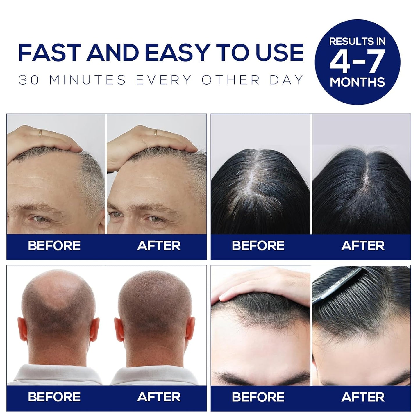 Laser Hair Growth Cap, Red Light Therapy Cap, Low Level Laser Therapy (LLLT) Equipment for Promoting Hair Growth in Women and Men（Black）