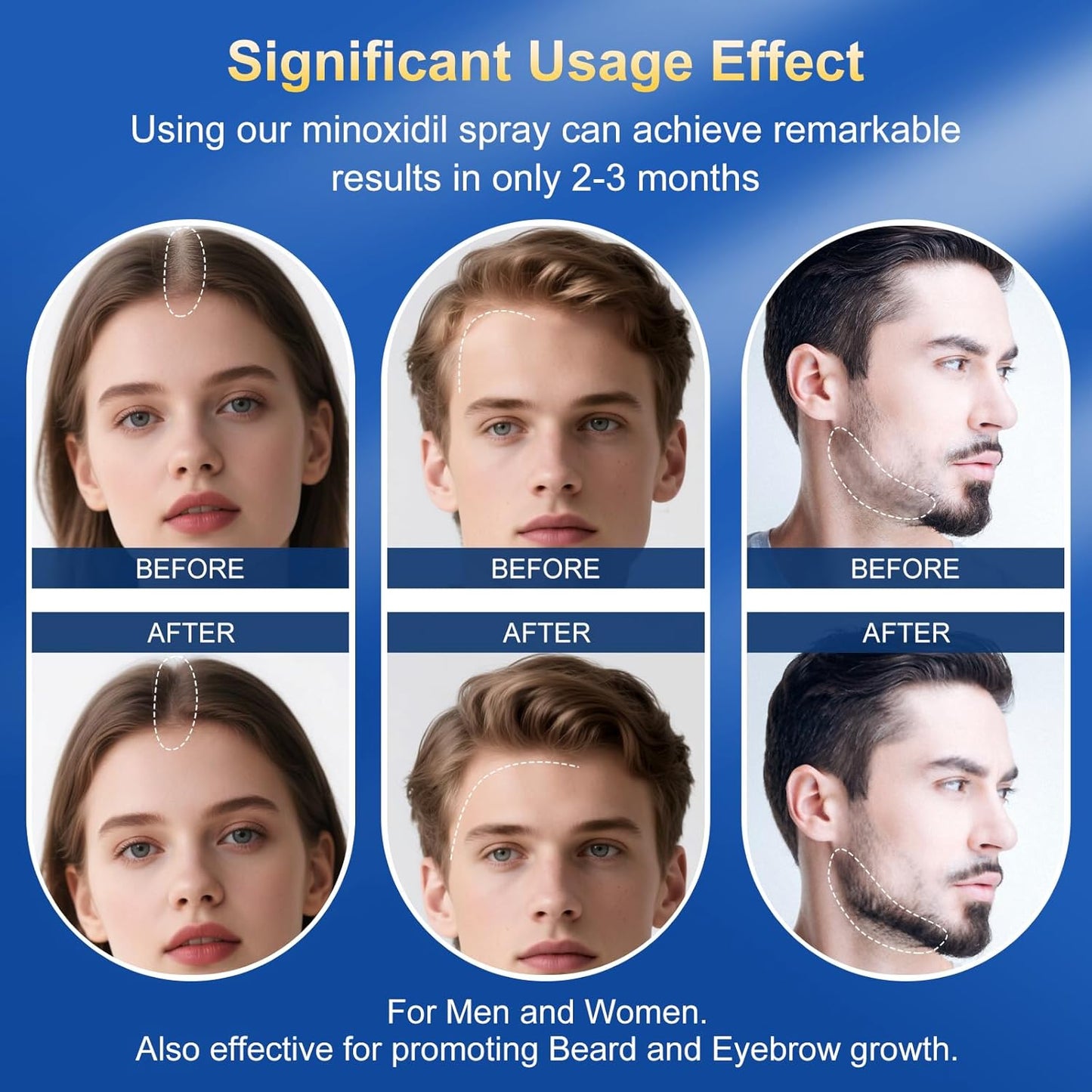 5% Minoxidil for Men & Women - Hair Growth Serum & Hair Regrowth Treatment | Extra Strength with Biotin | 6-Month Supply 4-Pack (14 fl oz) | Clinically Proven for Hair Loss & beard growth