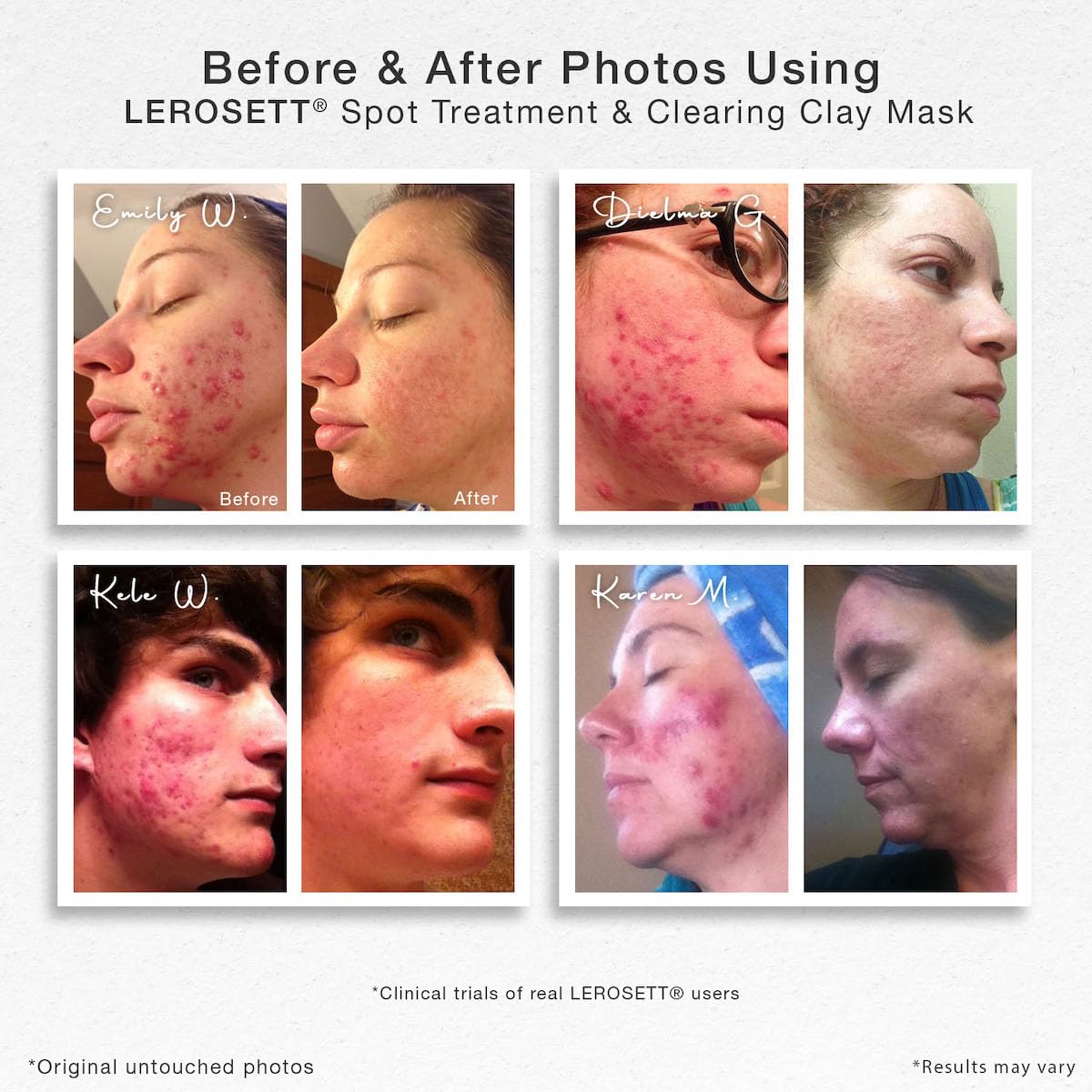 LEROSETT Facial Clay Mask for Acne, Oily Skin, Visibly Tightens Pores. Overnight Spot Treatment for Pimples, Blemishes, Cysts, Blackheads. 100% Natural, Spa-Grade, Made in Sweden Since 1987