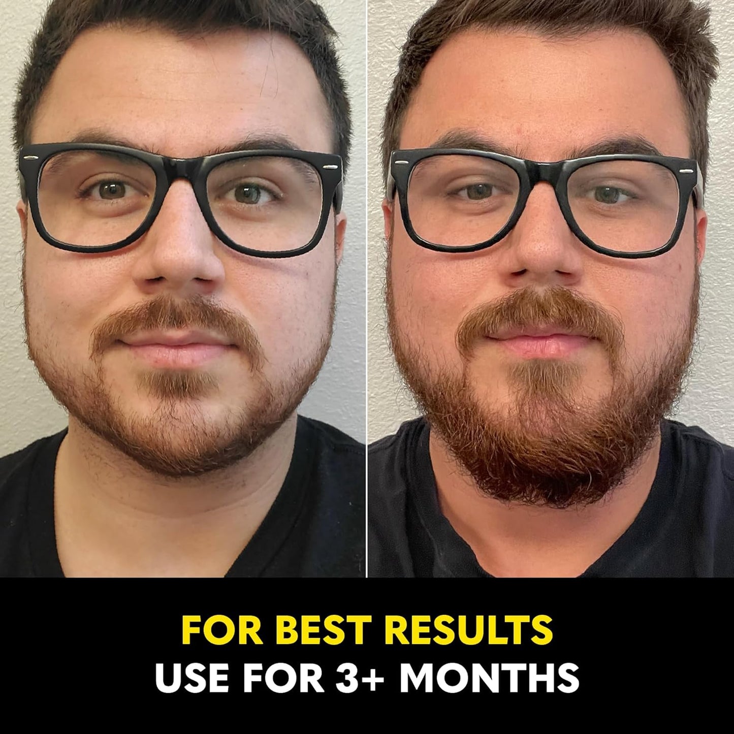 The Beard Club - Biotin Beard Growth Vitamins - Support A Thicker Fuller Beard, Fill in Patches - Minerals & Multi-Vitamins Help Support and Stimulate Healthier Facial Hair Growth