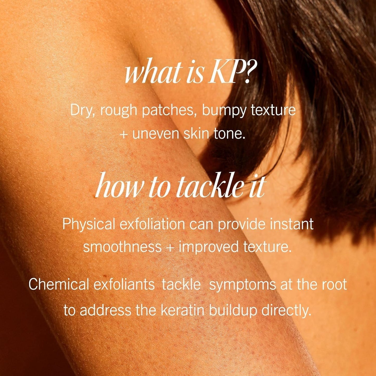 First Aid Beauty KP Bump Eraser Body Scrub with 10% AHA, Keratosis Pilaris Skin Exfoliator with Glycolic and Lactic acids, Helps Reduce Chicken Bumps, Safe for Sensitive Skin, 8 oz