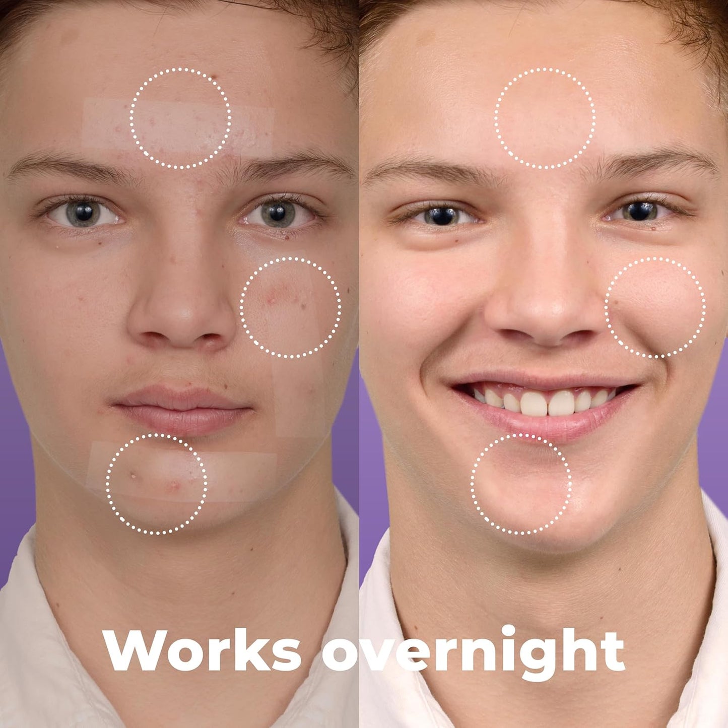 Large Pimple Patches for Face (20 Pack), Treat Blemishes Overnight, Hydrocolloid Acne Patch, Hydrocolloid Bandages, Big Pimple Patches, Large Acne Patch