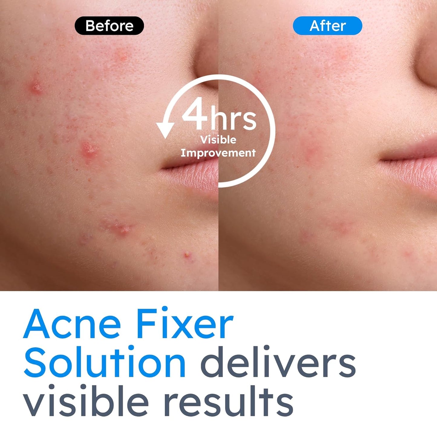 Blissberry Acne Gel - 1.5% Salicylic Acid, Acne Spot Gel For Blackheads & Whiteheads, Unclog Pores and Promote Pimple Healing, Alcohol Free & Oil Free, 0.5 Fl Oz